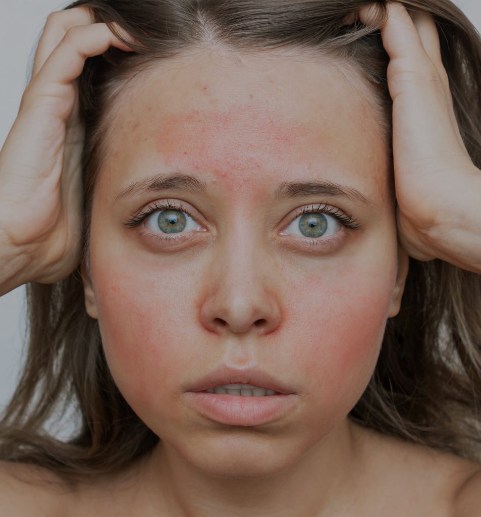 Rosacea archives medical spa toronto